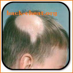 How to get rid of Alopecia icon