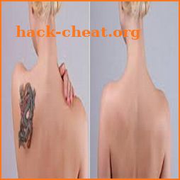 How to Remove a Tattoo icon