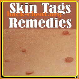 Skin tags Treatment and Home Remedies To Remove icon
