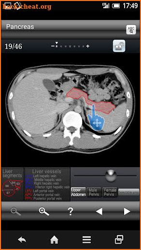 Abdominal CT Sectional Walker screenshot