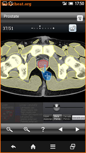 Abdominal CT Sectional Walker screenshot