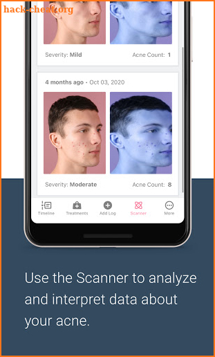 AcneLog: Track your Acne Healing Progress screenshot