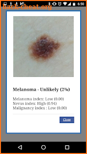 AI Melanoma (Skin Cancer) Detection screenshot