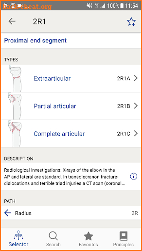 AO/OTA Fracture Classification screenshot