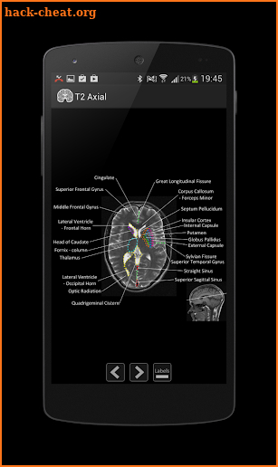 Atlas of MRI Brain Anatomy screenshot