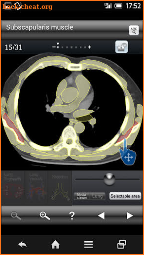 Chest CT Sectional Walker screenshot