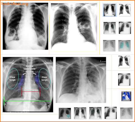 Chest X-Ray And Pathology screenshot