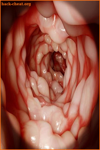 Crohn's Disease screenshot
