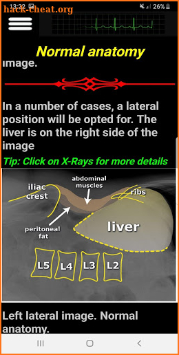 Easy Abdominal X-Ray screenshot