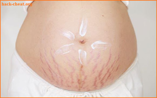 Get Rid Of Stretch Marks Naturally screenshot