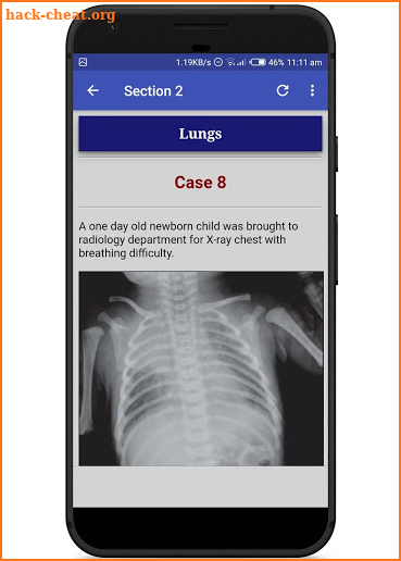Interpret Chest X-Ray With 100 Cases screenshot