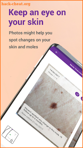 Miiskin - Melanoma Skin Cancer screenshot
