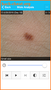 MySkinPal - Skin Cancer App screenshot