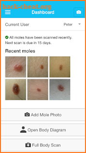 MySkinPal - Skin Cancer App screenshot