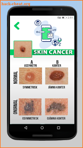 Skin Cancer screenshot