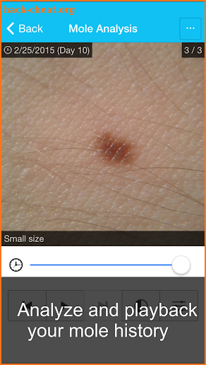 Skin Cancer App - MySkinPal screenshot