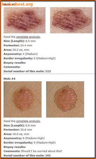 Skin Mole Analysis screenshot