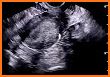 Embarazo: Seguimiento y control related image