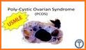 PCOS (Polycystic Ovary Synd.) related image