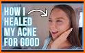 MDacne - Custom Acne Treatment related image