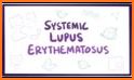 Lupus: Causes, Diagnosis, and Treatment related image