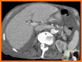 Abdominal CT Sectional Walker related image