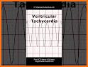 ECG FlashCards 2 - Reference App Most common EKGs related image