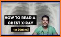 Chest X-Ray Interpretation related image