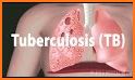 Tuberculosis Disease related image