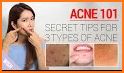 Acne Care related image