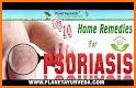 Psoriasis natural treatment related image
