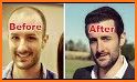 Hair Transplantation Istanbul / How Much Grafts? related image