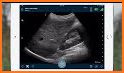 Clarius Ultrasound App related image