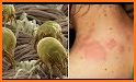 Scabies Natural & Home Remedies related image