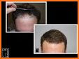 IHI - Hair Restoration Chicago related image