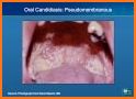 HIV Oral Diseases related image