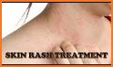 Skin Rash Cure related image