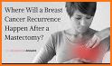 Breast cancer recurrence related image
