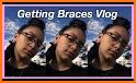 Braces 2018 related image