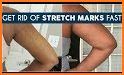 Get Rid of Body Stretch Marks related image