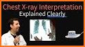 Interpretation Chest X Ray related image