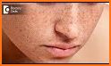 freckles tips related image