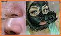Get Rid Of Blackheads Naturally - 12 Home Remedies related image