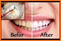 Whiten teeth naturally related image