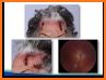 Polymyalgia Rheumatica and Giant Cell Arteritis related image
