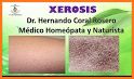 Xerosis Naturally Treatment related image