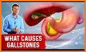 Gallstone Disease: Causes, Diagnosis,and Treatment related image