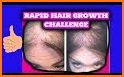 Baldness Thinning Hair related image