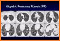 Rad Rounds - UIP to IPF related image