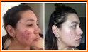 como curar el acne related image